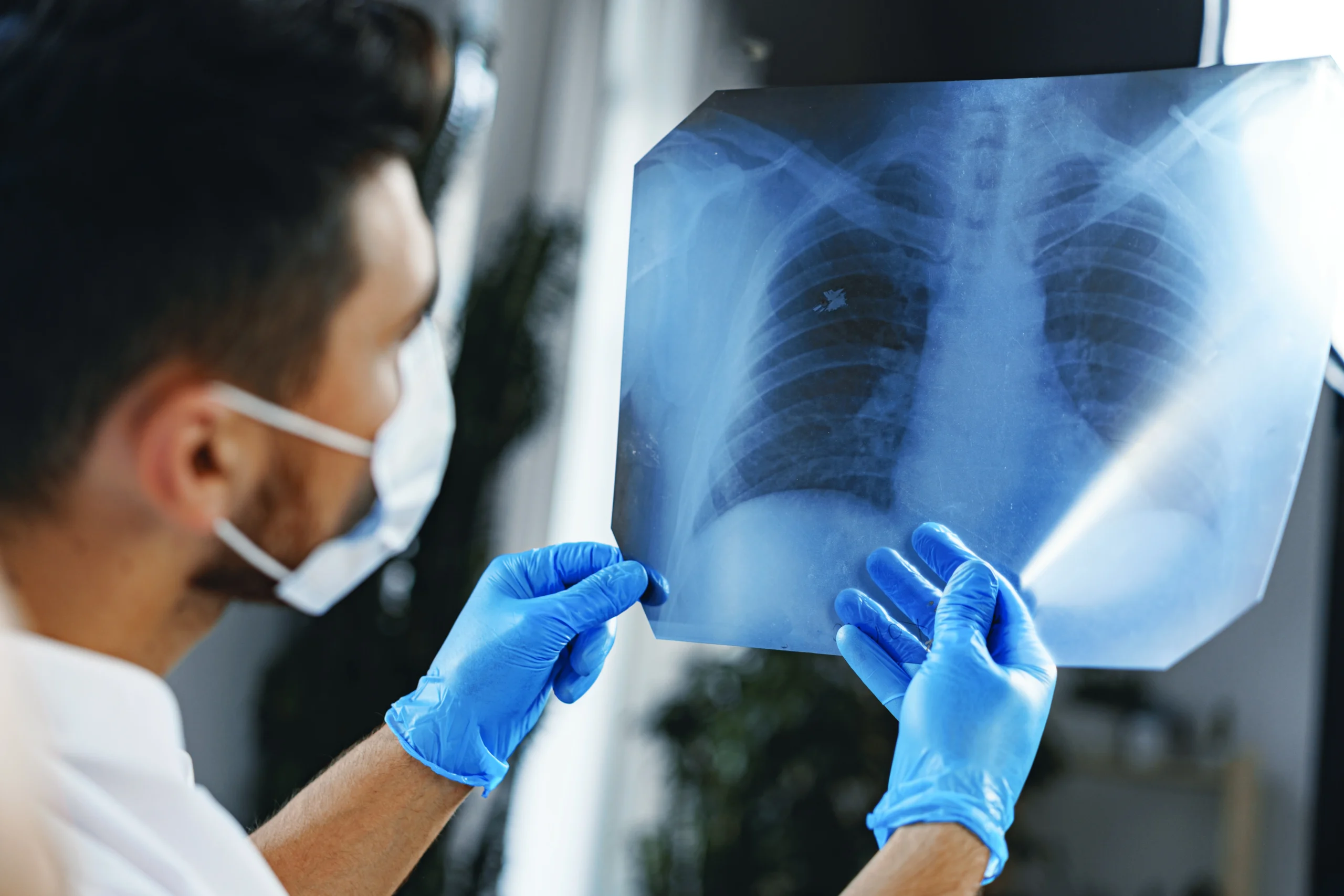 Doctor looking at lung xray